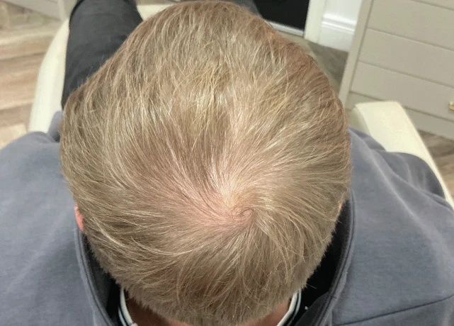 Case study: COMBINATION REGENERATIVE HAIR RESTORATION