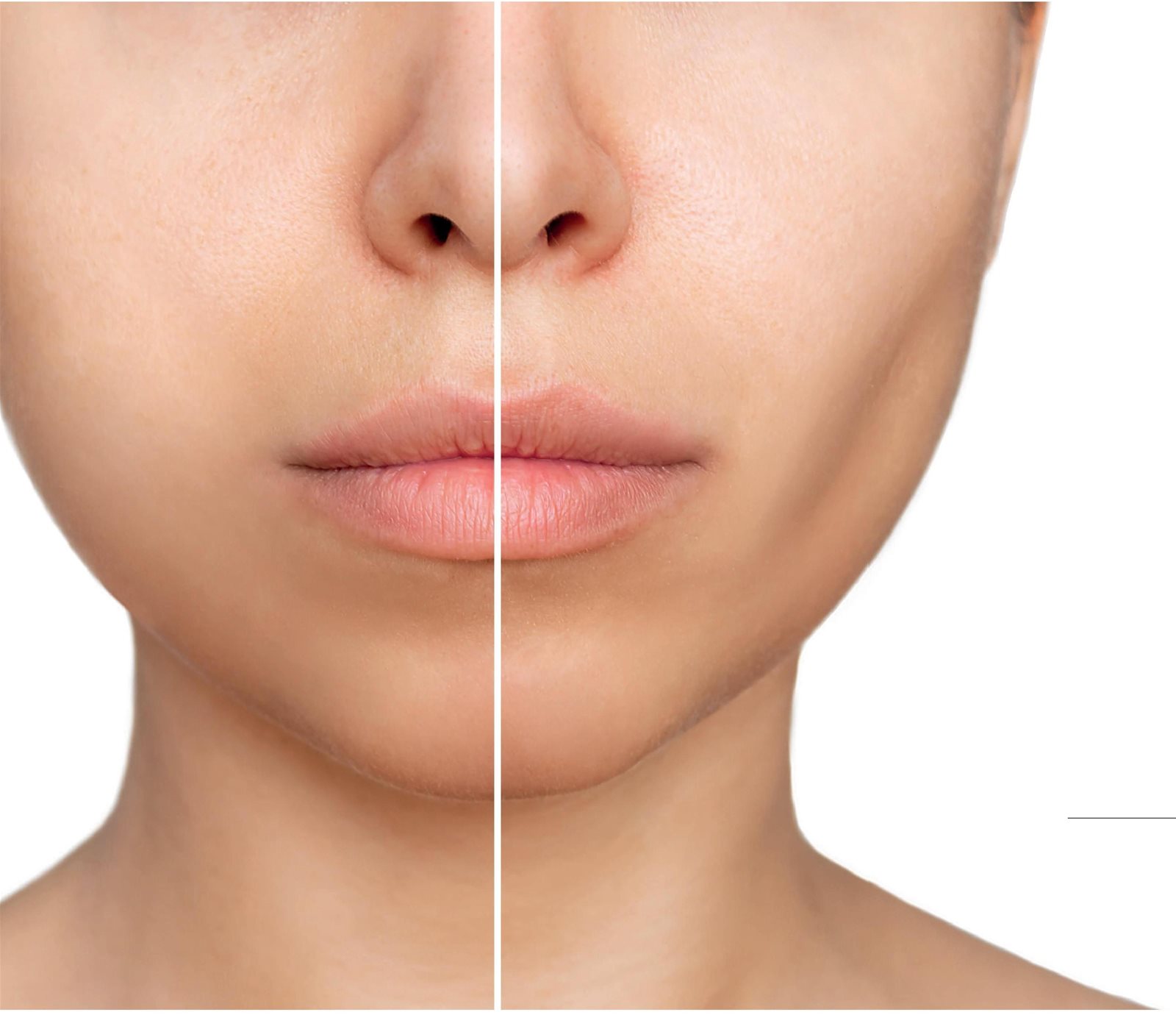 Exploring Buccal Fat Removal: Benefits & Aesthetic Considerations